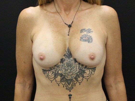 Breast Augmentation Case 42 - After