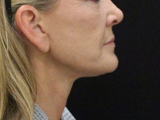 Face & Neck Lifts: Case 4 - After