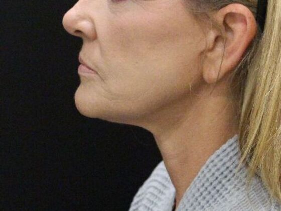 Face & Neck Lifts: Case 4 - After