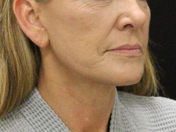 Face & Neck Lifts Case 4 - After