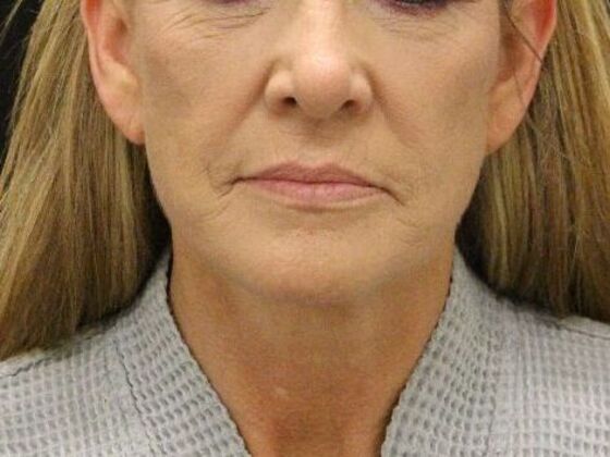 Face & Neck Lifts: Case 4 - After