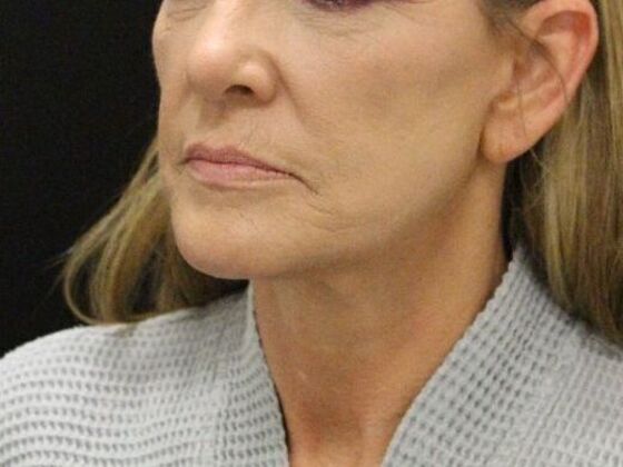 Face & Neck Lifts: Case 4 - After