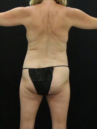 Tummy Tuck: Case 78 - Before