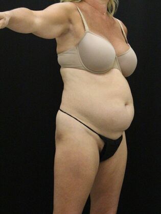 Tummy Tuck: Case 78 - Before