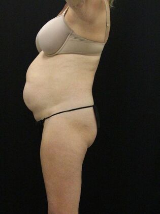 Tummy Tuck: Case 78 - Before