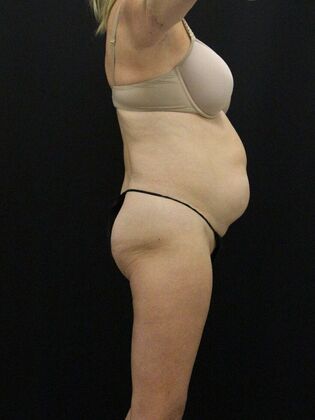 Tummy Tuck: Case 78 - Before