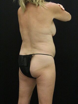 Tummy Tuck: Case 78 - Before