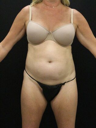 Tummy Tuck Case 78 - Before