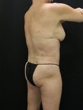 Tummy Tuck: Case 78 - After