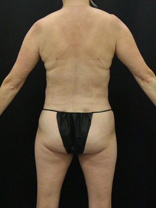 Tummy Tuck: Case 78 - After