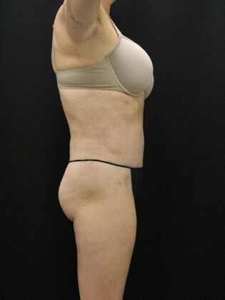 Tummy Tuck: Case 78 - After