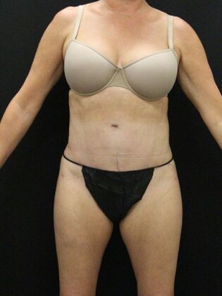 Tummy Tuck Case 78 - After