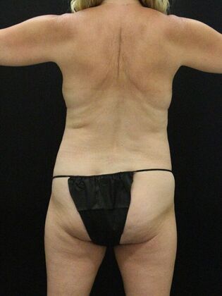 Liposuction: Case 68 - Before