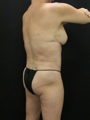 Liposuction: Case 68 - After