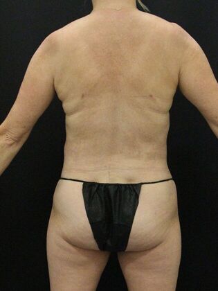 Liposuction: Case 68 - After