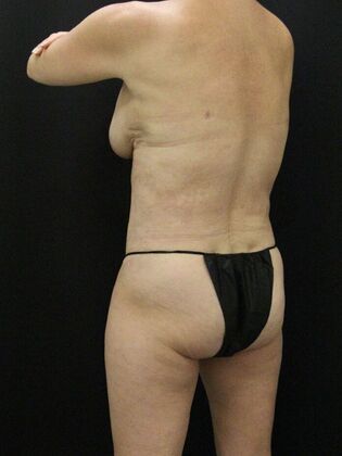 Liposuction Case 68 - After