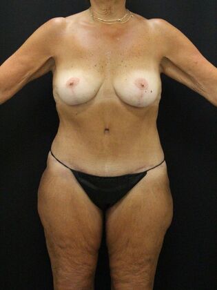 Tummy Tuck Case 79 - After