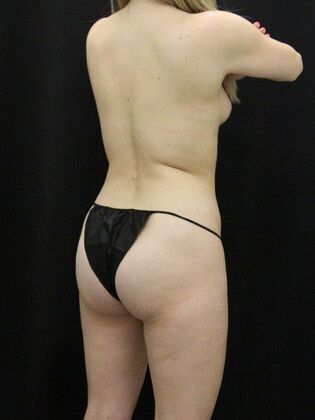 Liposuction: Case 70 - Before