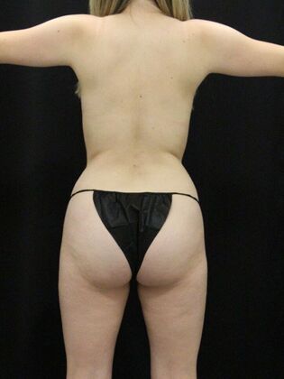 Liposuction Case 70 - Before