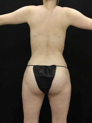 Liposuction Case 70 - After