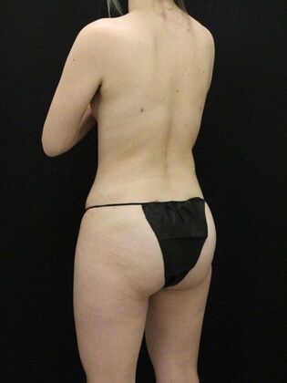 Liposuction: Case 70 - After