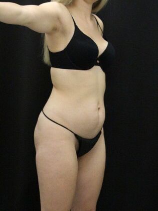 Tummy Tuck Case 80 - Before