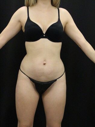 Tummy Tuck: Case 80 - Before