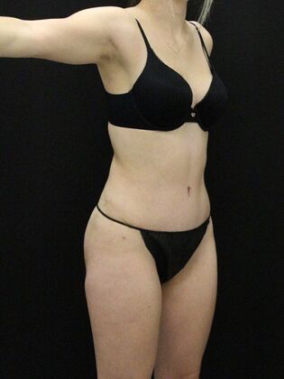 Tummy Tuck Case 80 - After