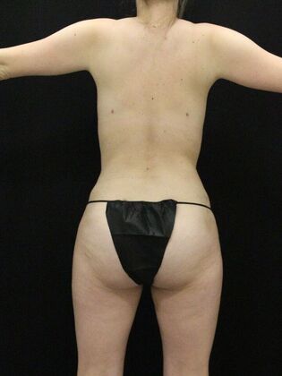 Tummy Tuck: Case 80 - After