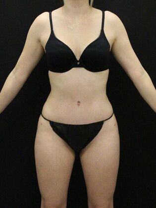 Tummy Tuck: Case 80 - After