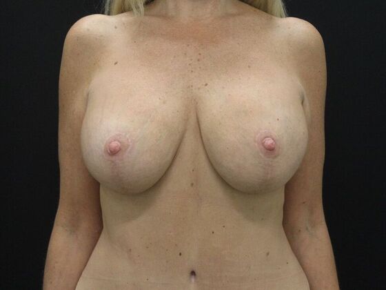 Breast Lift & Breast Lift Augmentation Case 65 - After