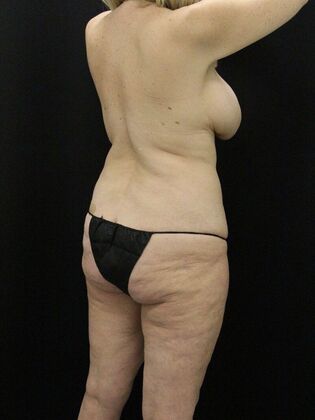 Tummy Tuck: Case 81 - Before
