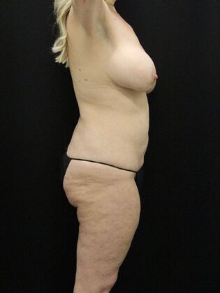 Tummy Tuck: Case 81 - Before