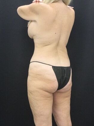 Tummy Tuck: Case 81 - After