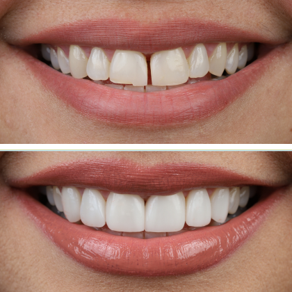 SmileSculpt Veneers Luz - Before