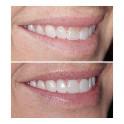Smile Gallery  Case 1 - Prepless Veneers 