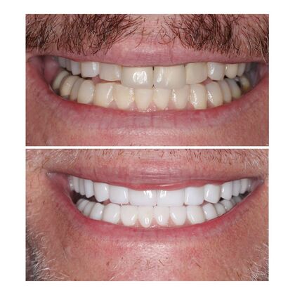 Smile Gallery  Case 3 - Smile Makeover