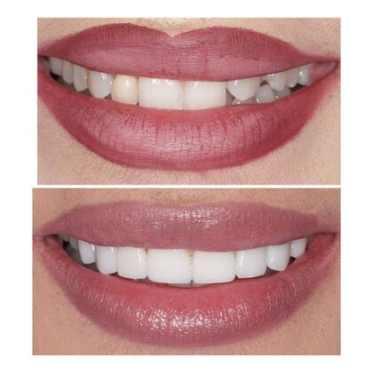 Smile Gallery  Case 5 - Prepless Veneers