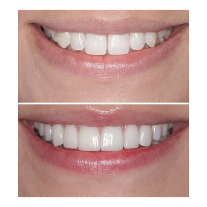 Smile Gallery  Case 7 - Prepless Veneers