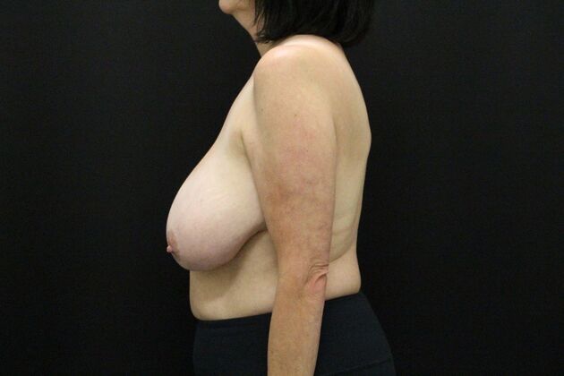 Breast Reduction: Case 33 - Before