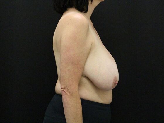 Breast Reduction: Case 33 - Before