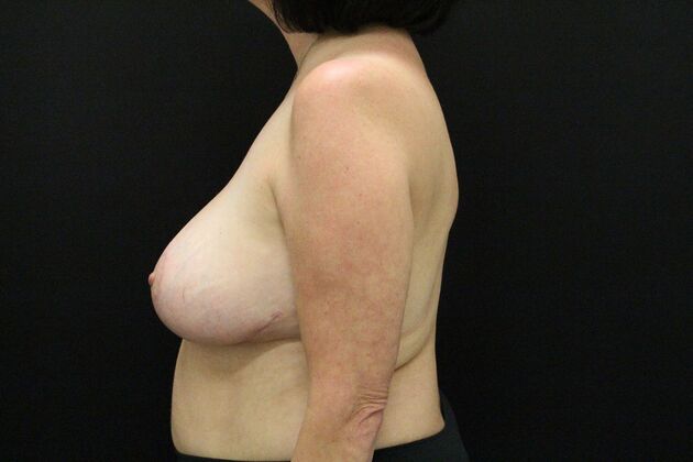 Breast Reduction: Case 33 - After