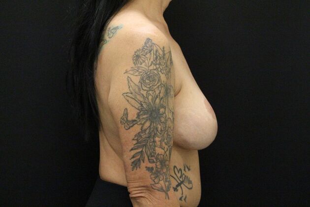 Breast Augmentation Exchange/Revision: Case 26 - Before