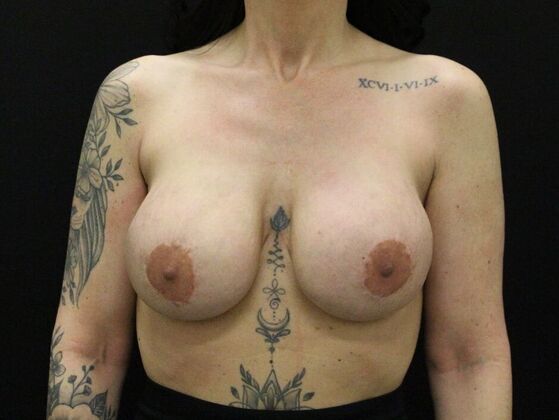 Breast Augmentation Exchange/Revision: Case 27 - Before