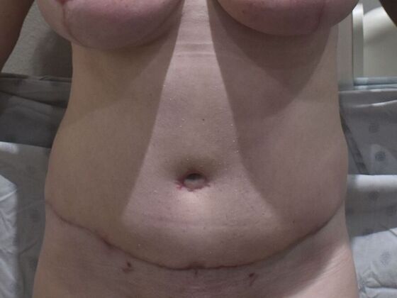 Tummy Tuck (Abdominoplasty): Case 560 - After