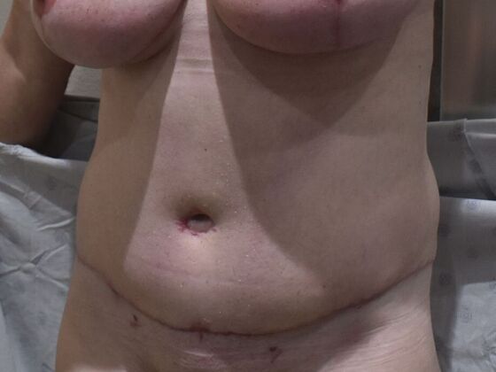 Tummy Tuck (Abdominoplasty): Case 560 - After