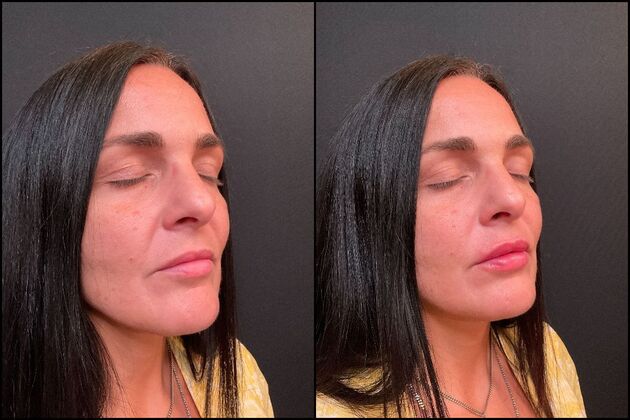 Dermal Fillers Lip Filler, Brick, NJ 3 - Before