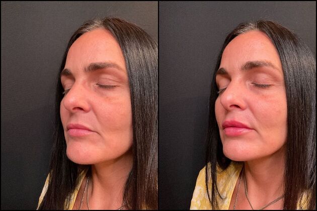 Dermal Fillers Lip Filler, Brick, NJ 3 - After