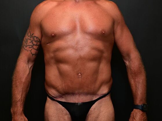 Male Procedures Case 1 - After