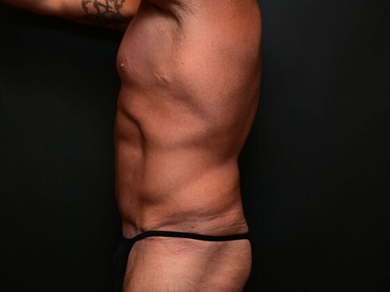 Male Procedures: Case 1 - After